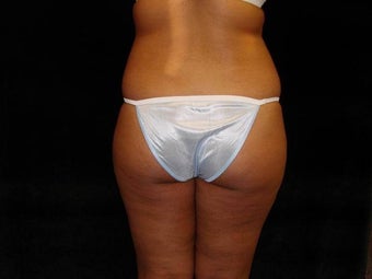 Buttocks Augmentation by Fat Transfer before 186433